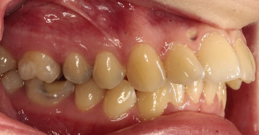 innvisalign-przed2 https://ortodent.com.pl/wp-content/uploads/2026/07/innvisalign-przed2.webp