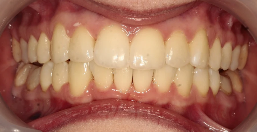 invisalign-po https://ortodent.com.pl/wp-content/uploads/2026/07/invisalign-po.webp