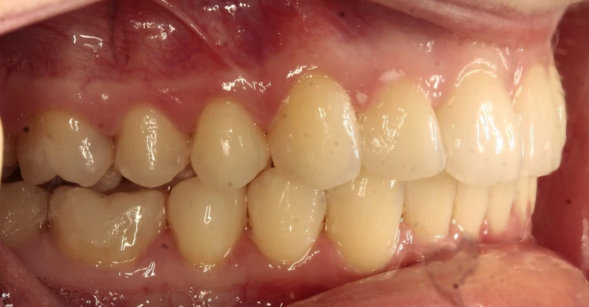 invisalign-po2 https://ortodent.com.pl/wp-content/uploads/2026/07/invisalign-po2.webp