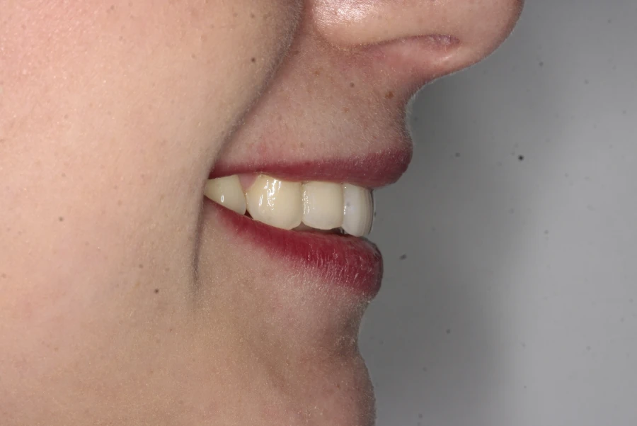 invisalign-po3 https://ortodent.com.pl/wp-content/uploads/2026/07/invisalign-po3.webp