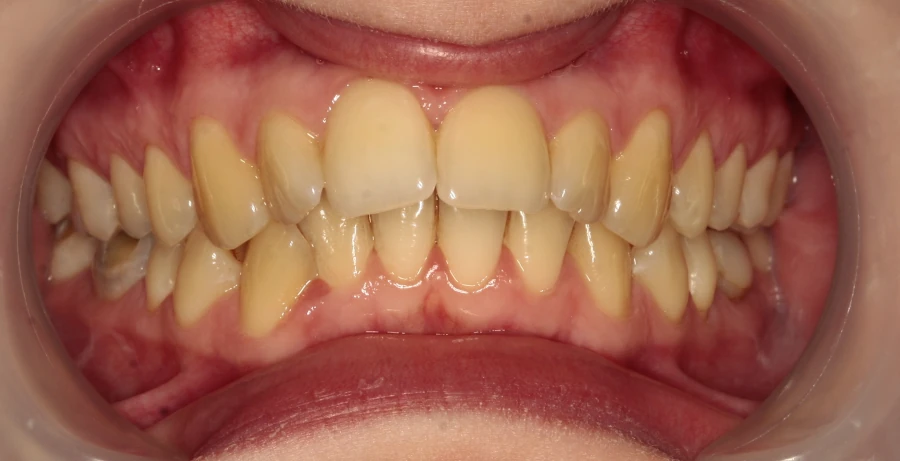 invisalign-przed https://ortodent.com.pl/wp-content/uploads/2026/07/invisalign-przed.webp