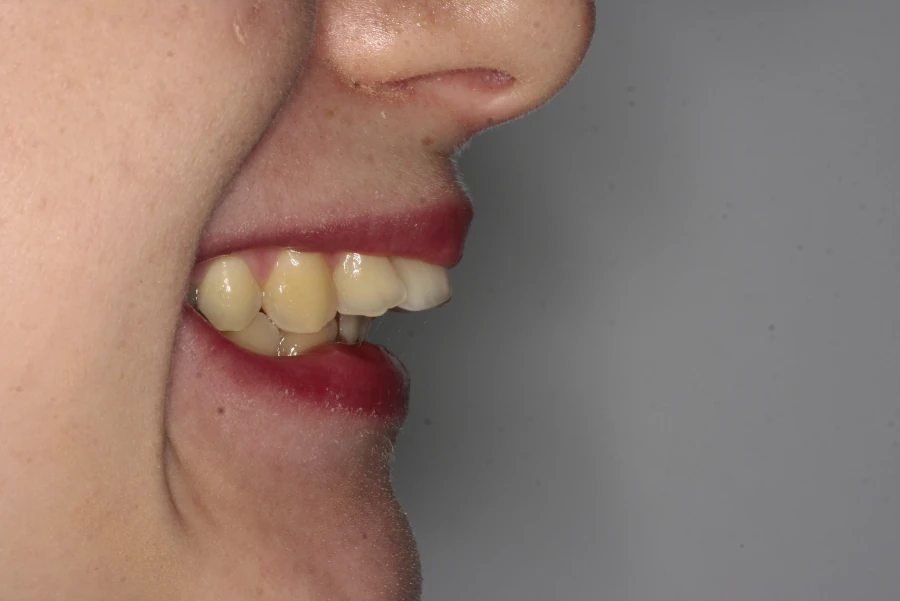 invisalign-przed3 https://ortodent.com.pl/wp-content/uploads/2026/07/invisalign-przed3.webp
