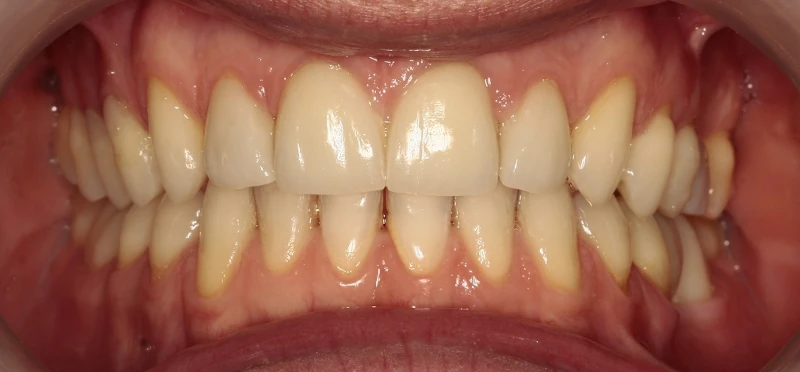 metamorfoza-invisalign-po Metamorfoza po