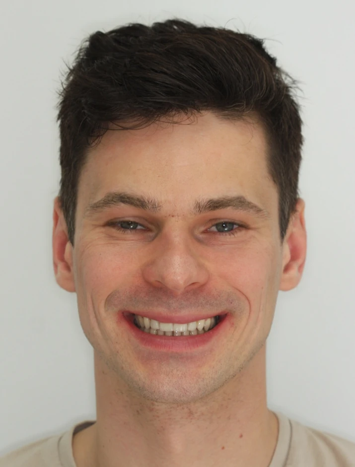 metamorfoza-invisalign-po2 Metamorfoza po