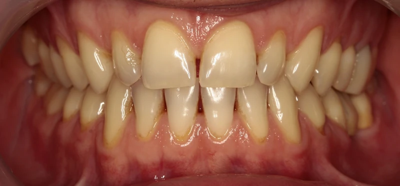 metamorfoza-invisalign-przed Metamorfoza przed